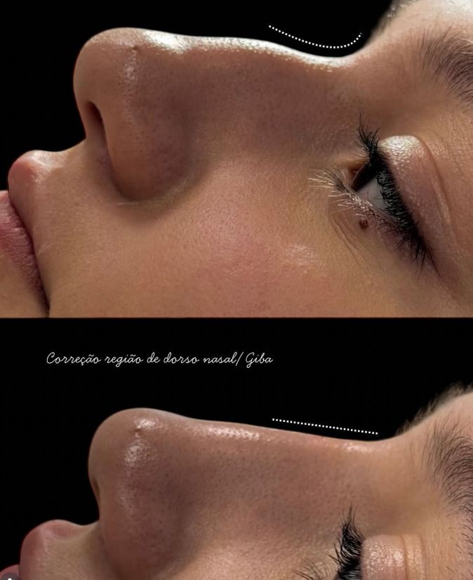 Antes e depois de correção do dorso nasal